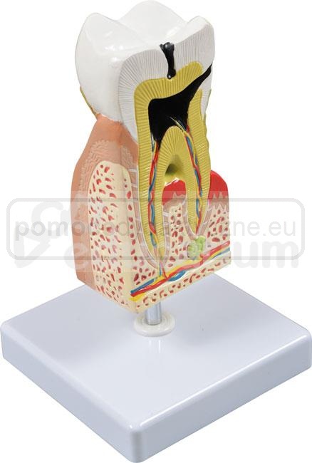 Model przekroju zęba trzonowego - budowa i trzy stany chorobowe