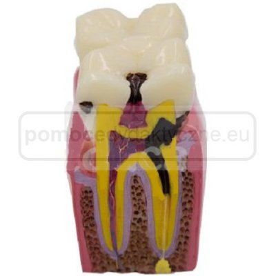 Model zęba ze zmianami chorobowymi
